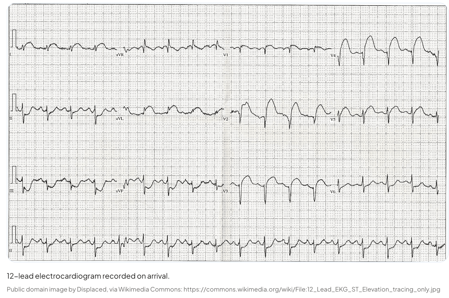 The real 12-lead ECG from the case, recorded on arrival. Public-domain image, attribution in the caption.